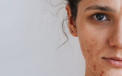 Microomics publishes two papers on the importance of microbiota in the treatment of acne